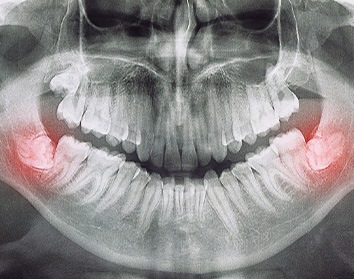 X-ray of impacted wisdom teeth