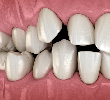 Illustration of spaced-out teeth