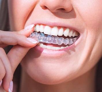 Closeup of woman putting on clear aligner