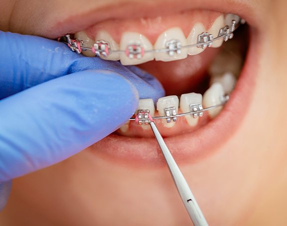 A closeup of a dentist adjusting a patient’s braces