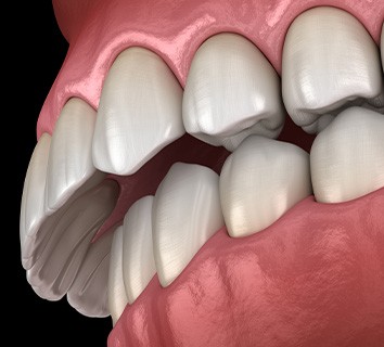 Illustration of overbite