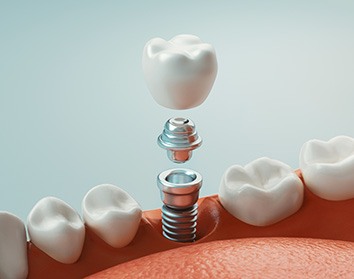 a digital illustration showing the parts of a dental implant