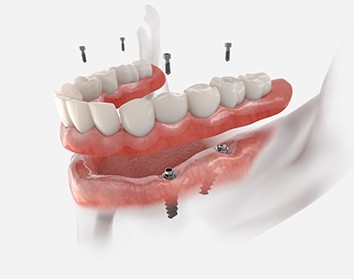 a digital illustration showing the parts of a dental implant