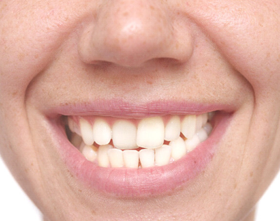 a closeup of a woman with crooked teeth