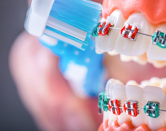 a closeup of teeth with traditional braces receiving brushing from a toothbrush