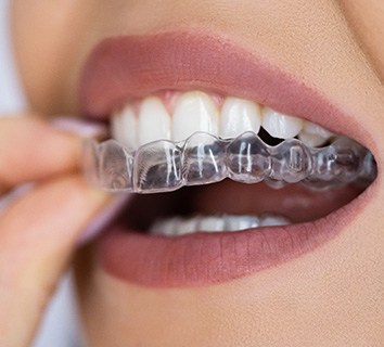 Closeup of patient putting on clear aligner