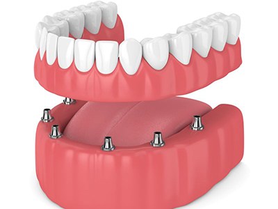 Illustration of implant dentures for lower dental arch