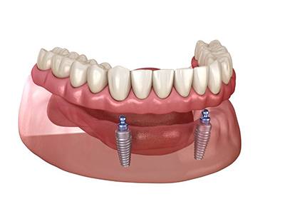 Illustration of implant dentures with ball-shaped attachments