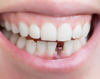 Closeup of someone’s mouth with a dental implant rod in the lower arch