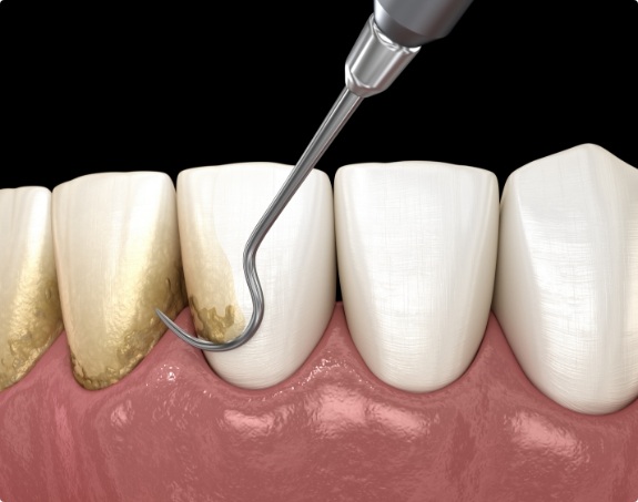 Animated smile during scaling and root planing treatment