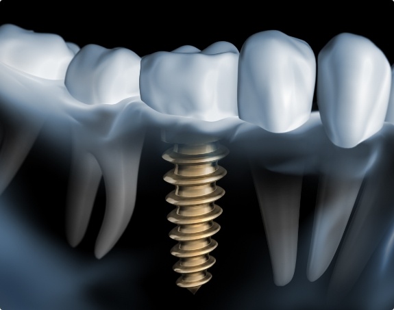 Animated smile with a dental implant supported dental crown