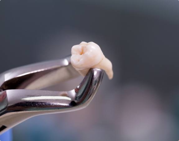 Metal clasp holding a tooth after extraction