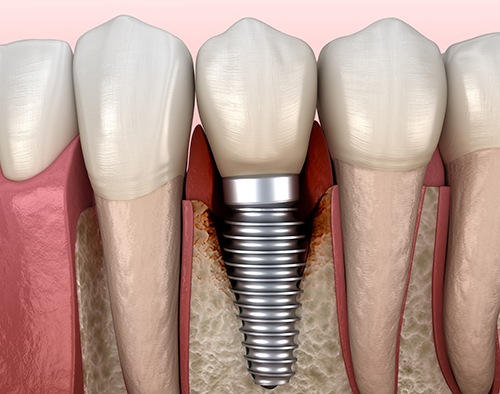 Illustration showing infected tissue around a dental implant