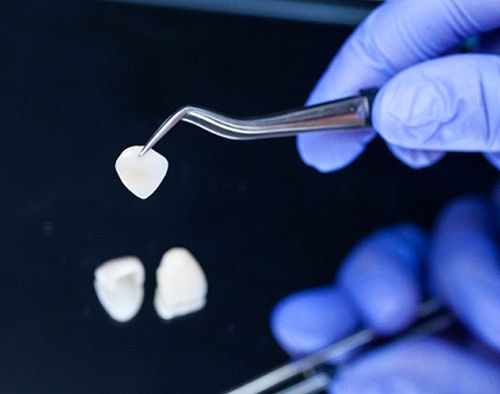 A dentist handling porcelain veneers with a tweezer