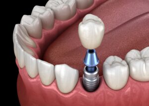 Dental implant replacing lower tooth