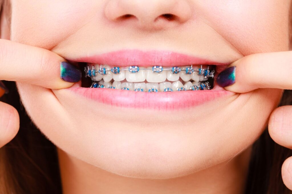 Woman pulling her lips aside to reveal braces with blue bands